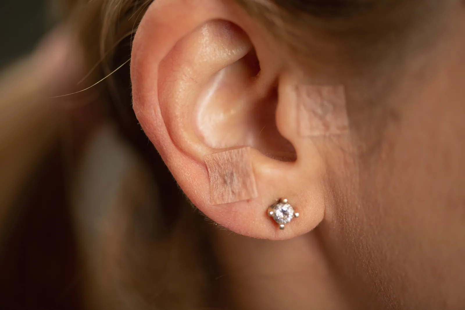 Ear Lobe Repair