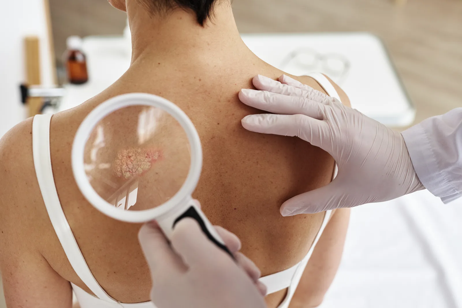 Mole Removal